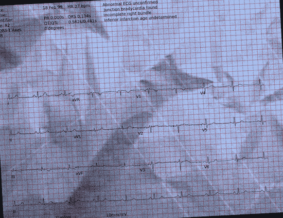 Normal ECG — PTB-XL