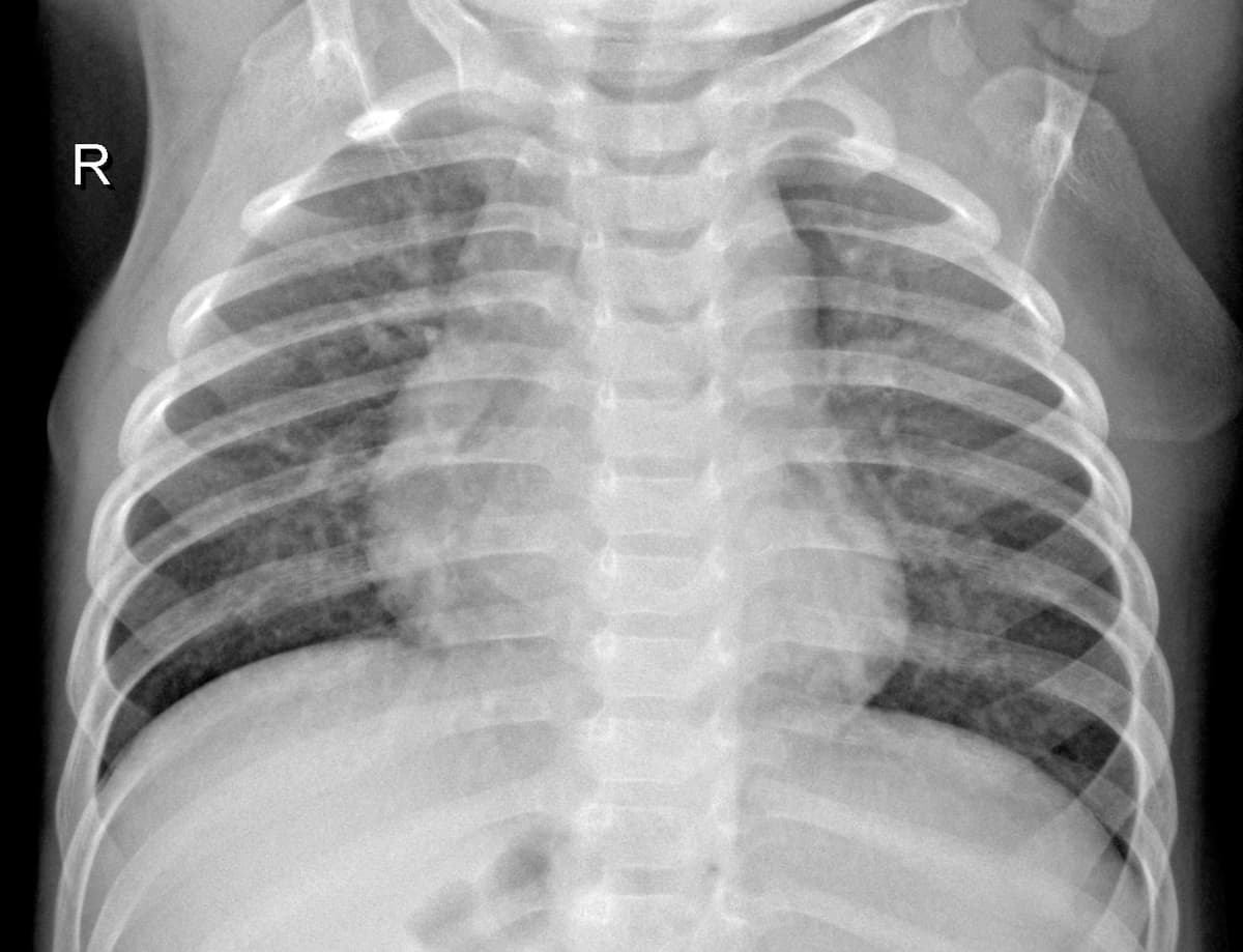 Radiografia Normal — NIH Chest X-ray14