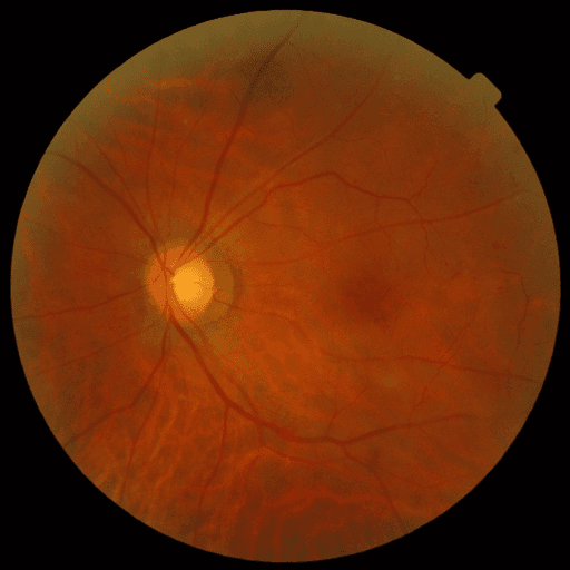 No Diabetic Retinopathy — MESSIDOR-2