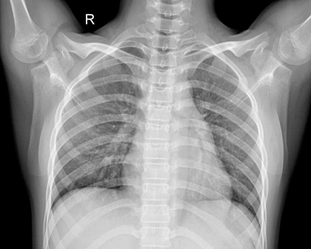 Radiografia Normal — NIH Chest X-ray14