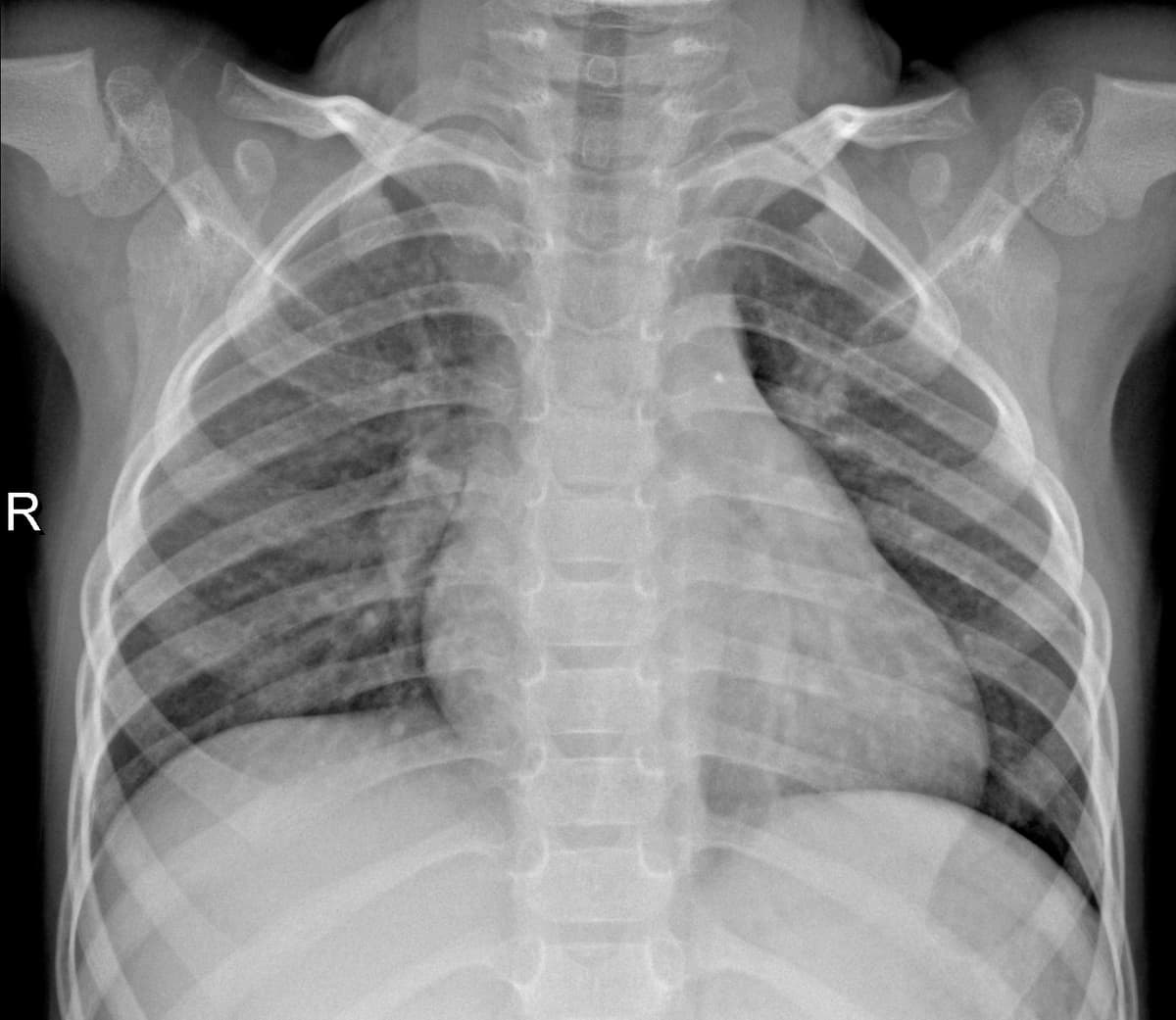 Radiografia Normal — NIH Chest X-ray14