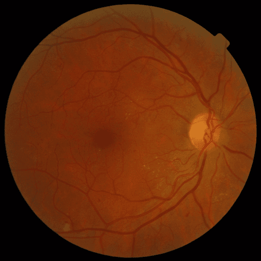 No Diabetic Retinopathy — MESSIDOR-2
