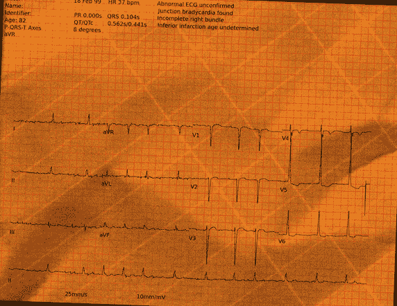 Normal ECG — PTB-XL