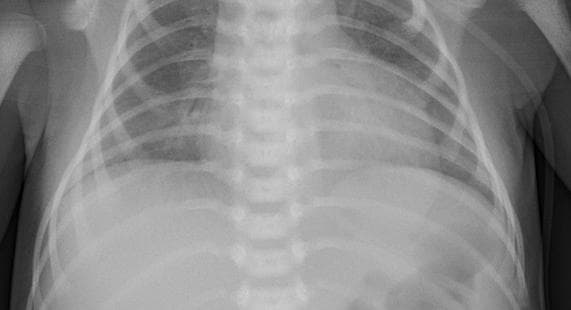 Pneumonia — NIH Chest X-ray14