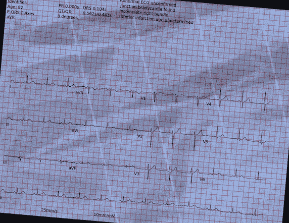 Normal ECG — PTB-XL