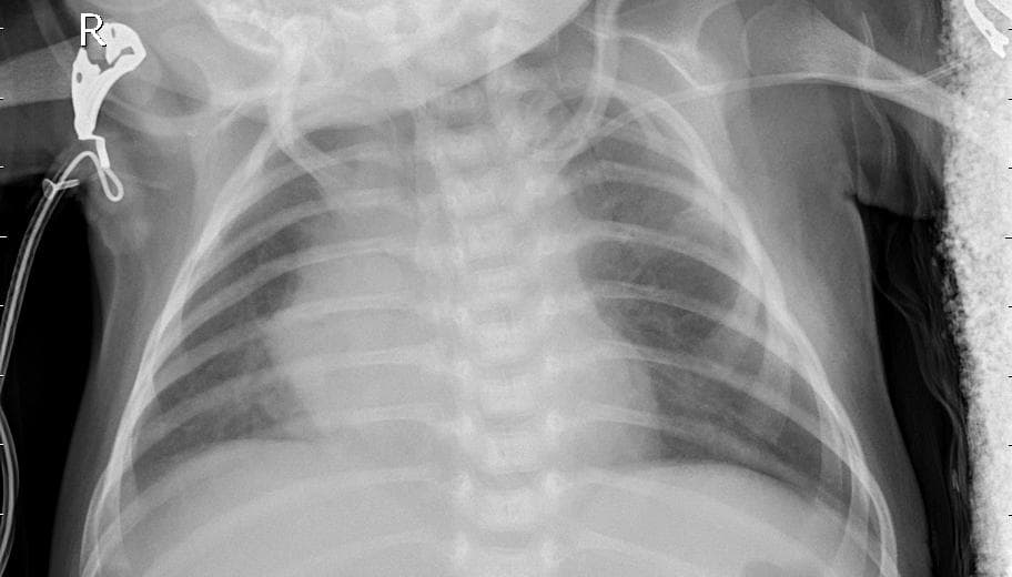 Pneumonia — NIH Chest X-ray14