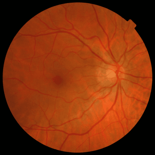 No Diabetic Retinopathy — MESSIDOR-2