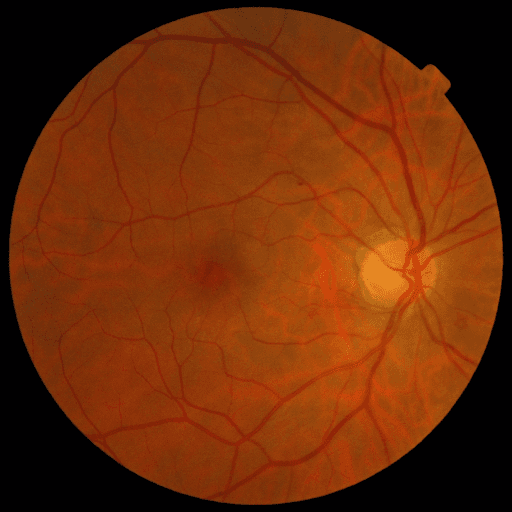 No Diabetic Retinopathy — MESSIDOR-2