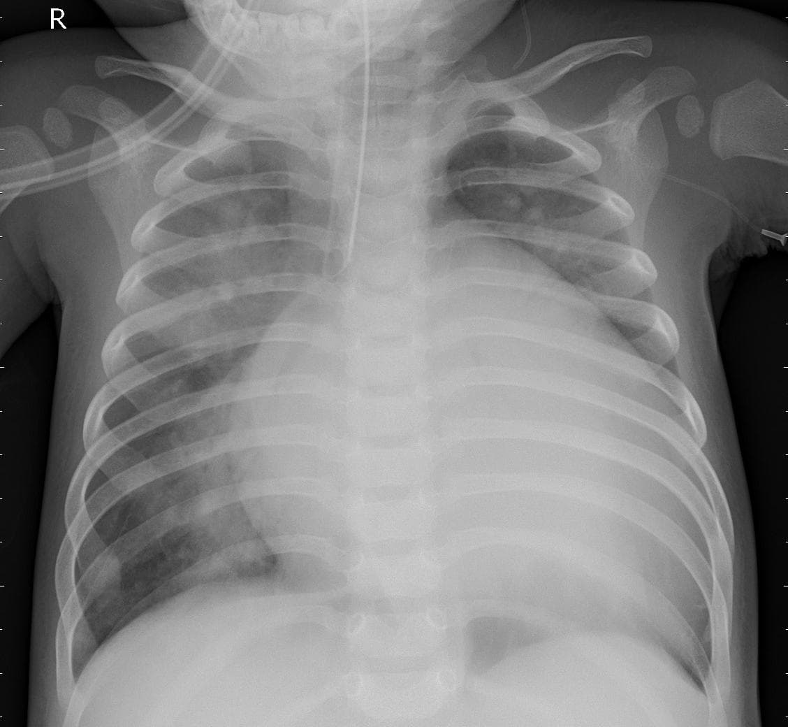 Pneumonia — NIH Chest X-ray14