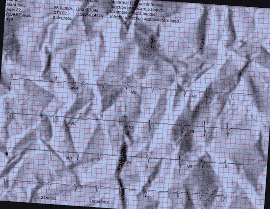 Normal ECG — PTB-XL
