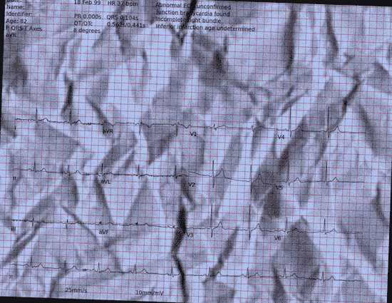 Normal ECG — PTB-XL