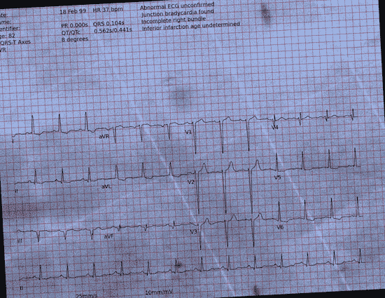 Normal ECG — PTB-XL