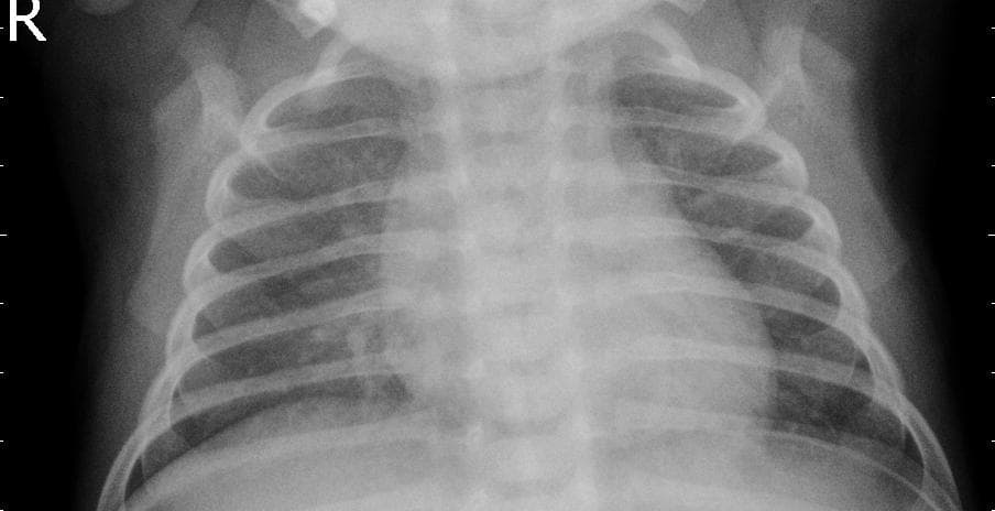 Pneumonia — NIH Chest X-ray14
