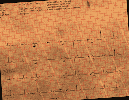 Normal ECG — PTB-XL