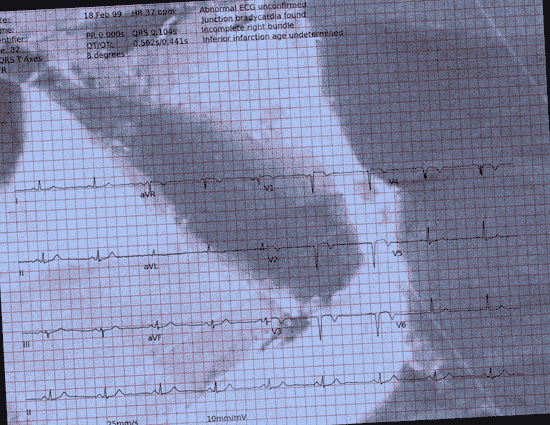 Normal ECG — PTB-XL