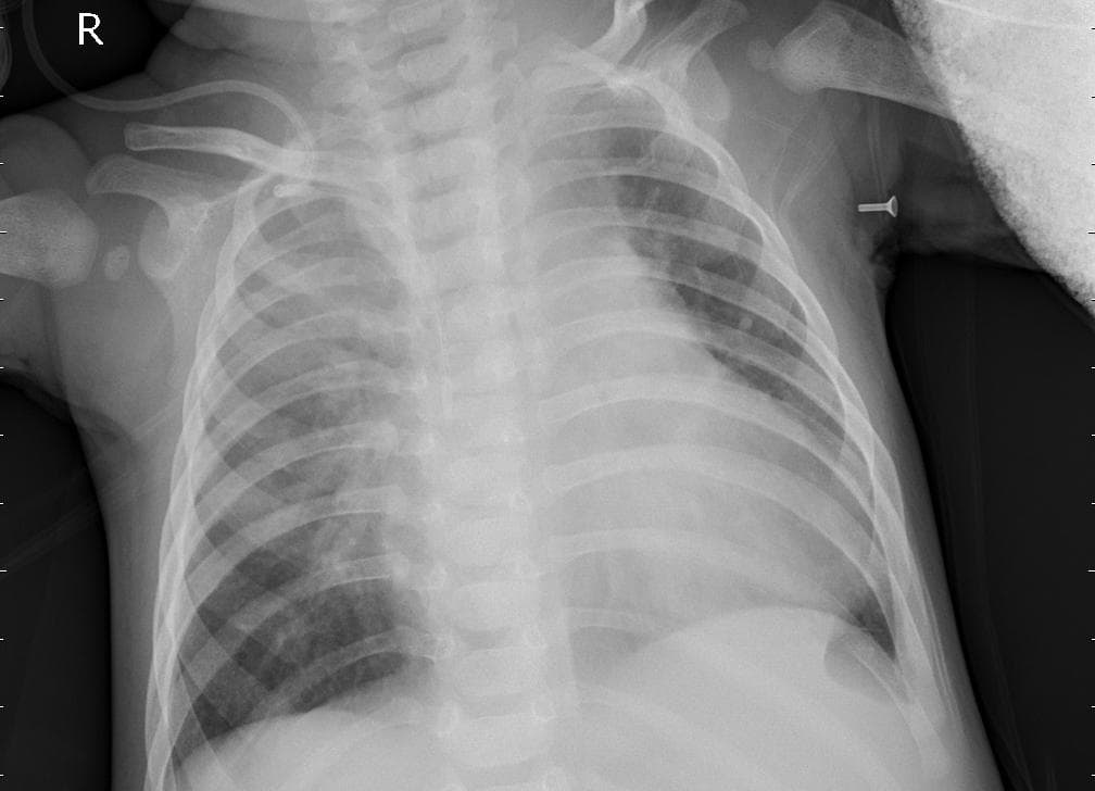 Pneumonia — NIH Chest X-ray14