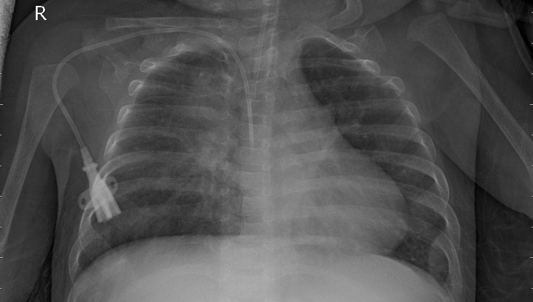 Pneumonia — NIH Chest X-ray14