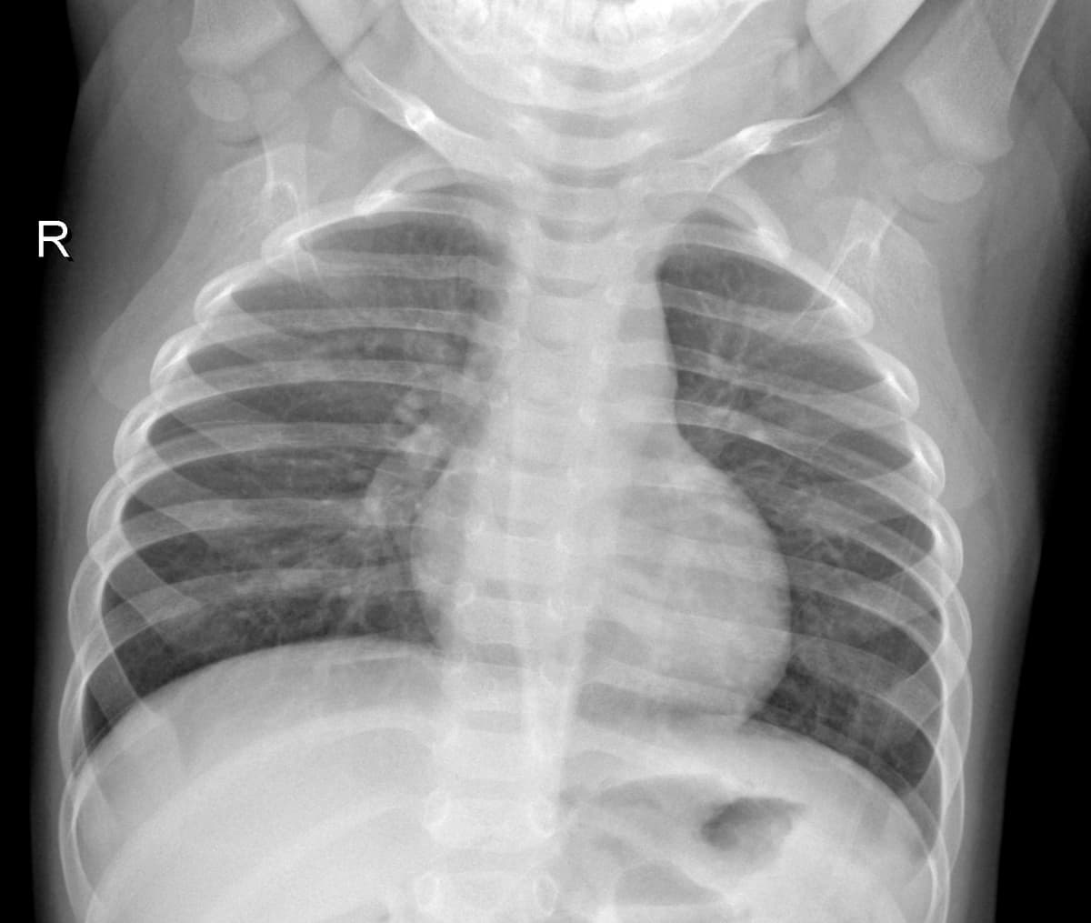 Radiografia Normal — NIH Chest X-ray14