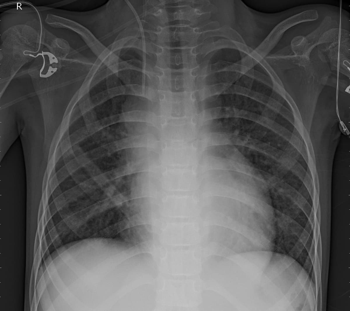 Pneumonia — NIH Chest X-ray14