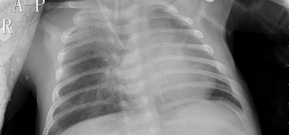 Pneumonia — NIH Chest X-ray14