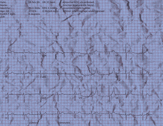 Normal ECG — PTB-XL