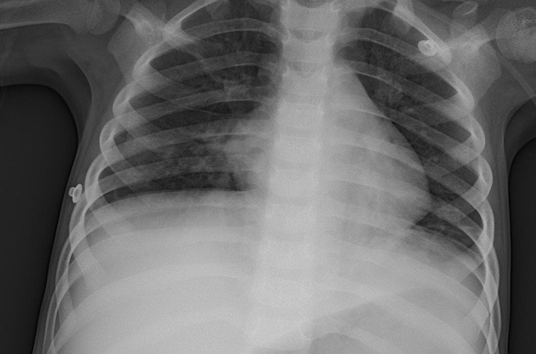 Pneumonia — NIH Chest X-ray14