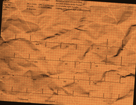 Normal ECG — PTB-XL
