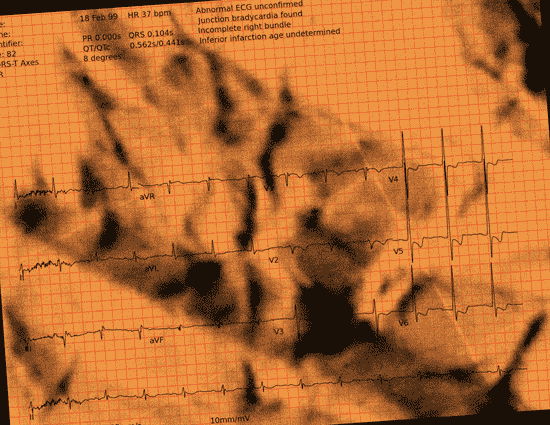Normal ECG — PTB-XL