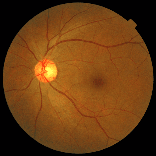 No Diabetic Retinopathy — MESSIDOR-2