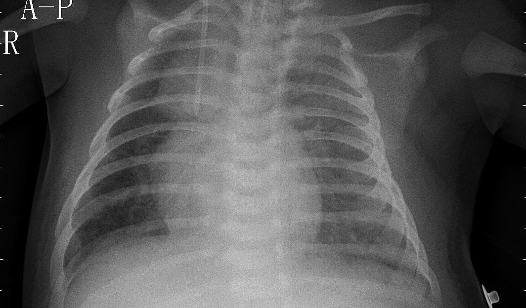 Pneumonia — NIH Chest X-ray14