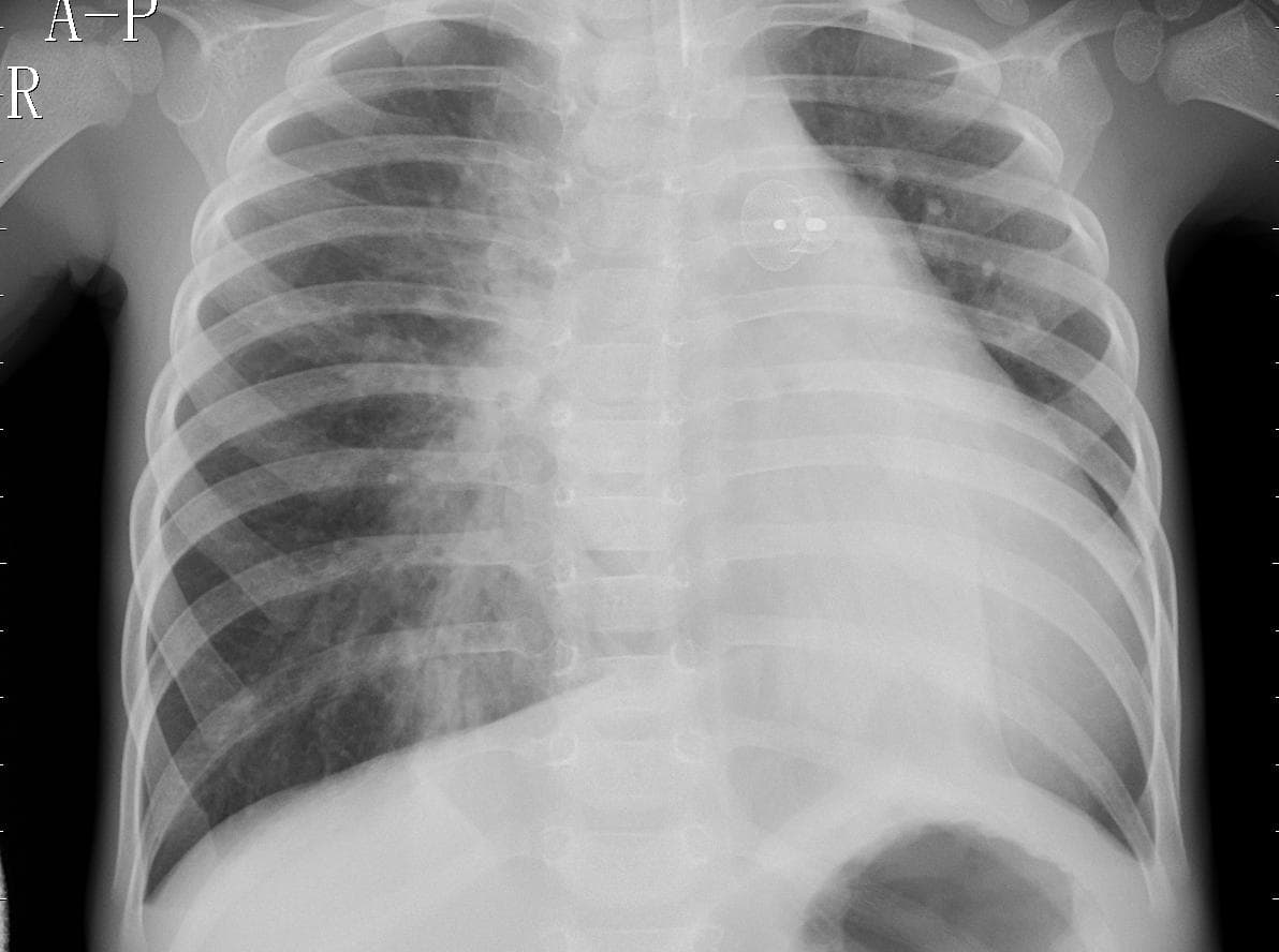 Pneumonia — NIH Chest X-ray14