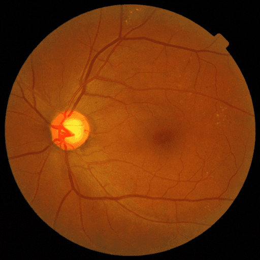 Proliferative DR — MESSIDOR-2