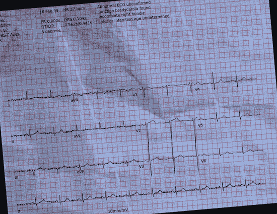 Normal ECG — PTB-XL