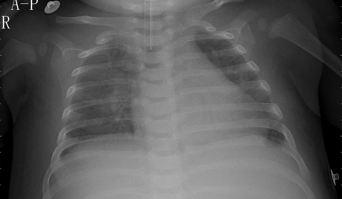 Pneumonia — NIH Chest X-ray14