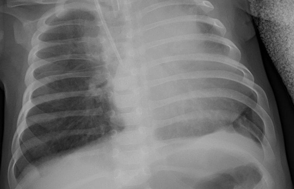 Pneumonia — NIH Chest X-ray14