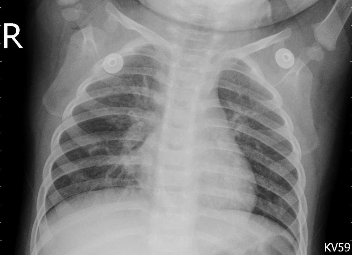 Pneumonia — NIH Chest X-ray14