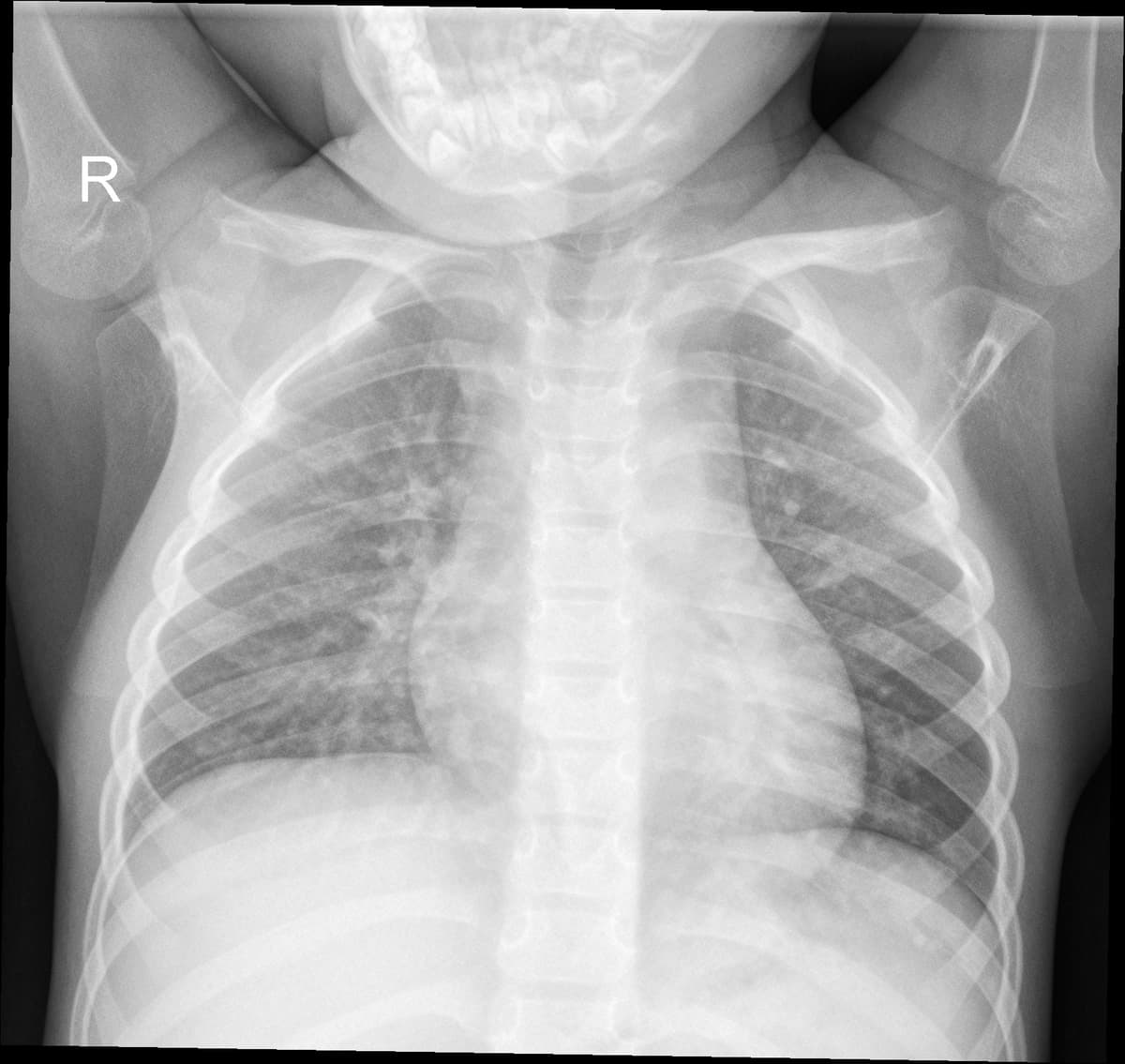 Radiografia Normal — NIH Chest X-ray14