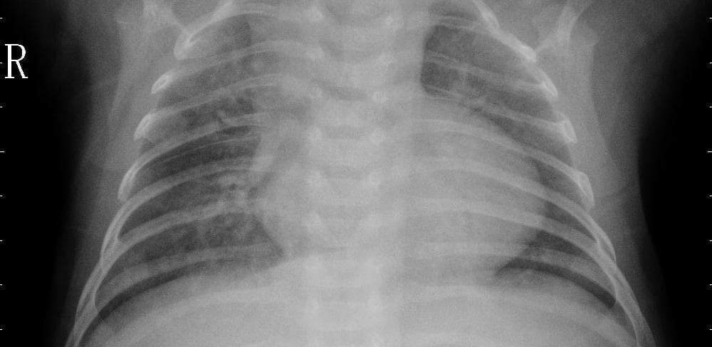 Pneumonia — NIH Chest X-ray14