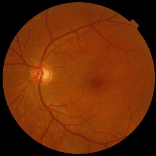 Proliferative DR — MESSIDOR-2