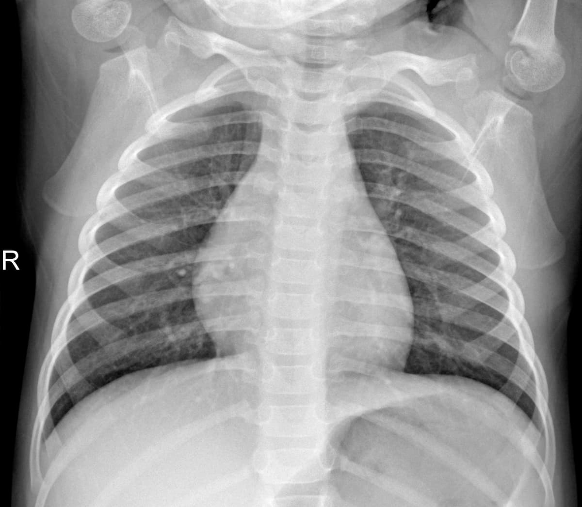 Radiografia Normal — NIH Chest X-ray14