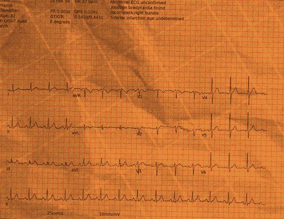 Left Bundle Branch Block — PTB-XL