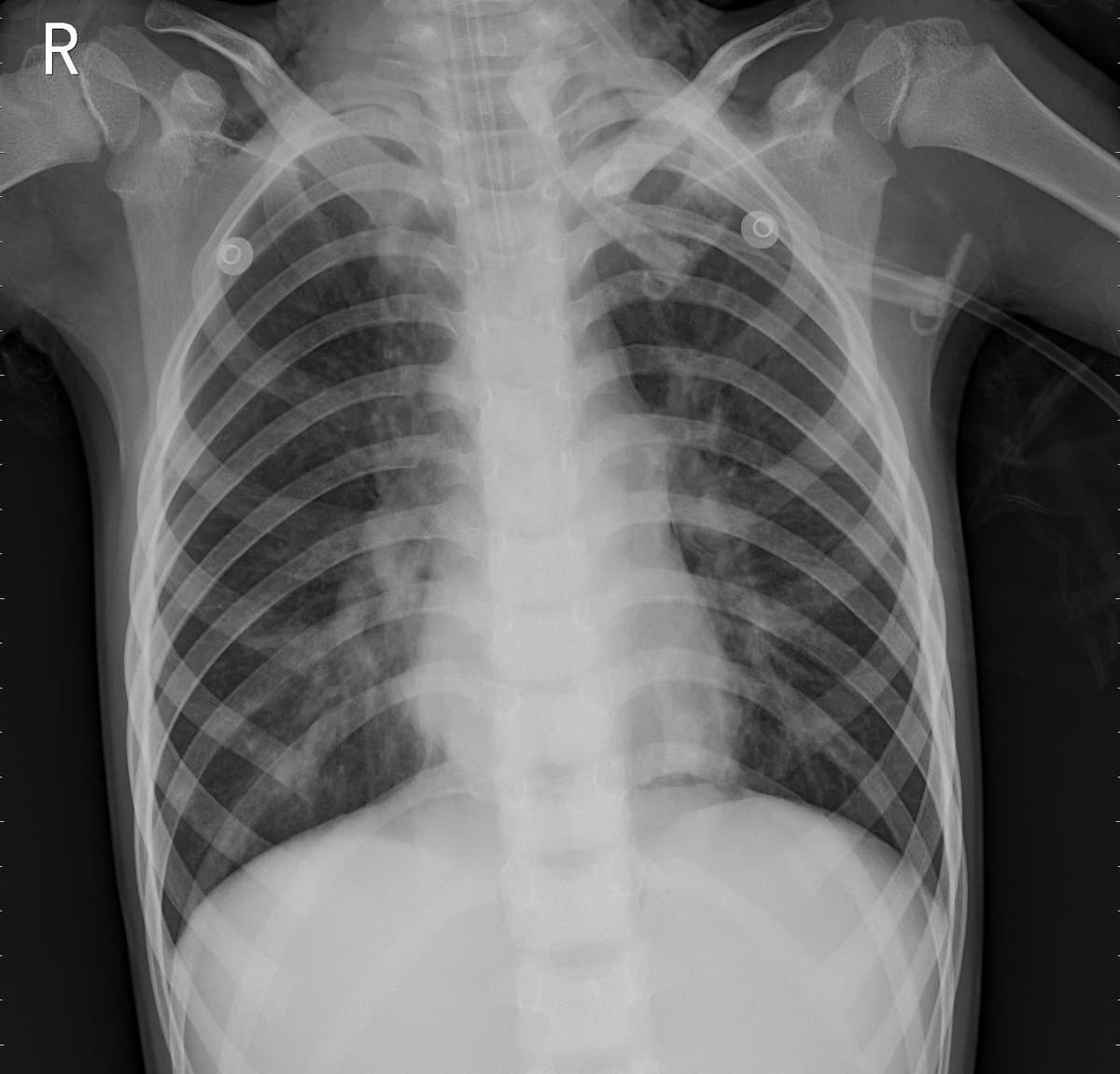 Pneumonia — NIH Chest X-ray14