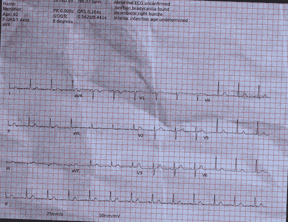 Normal ECG — PTB-XL