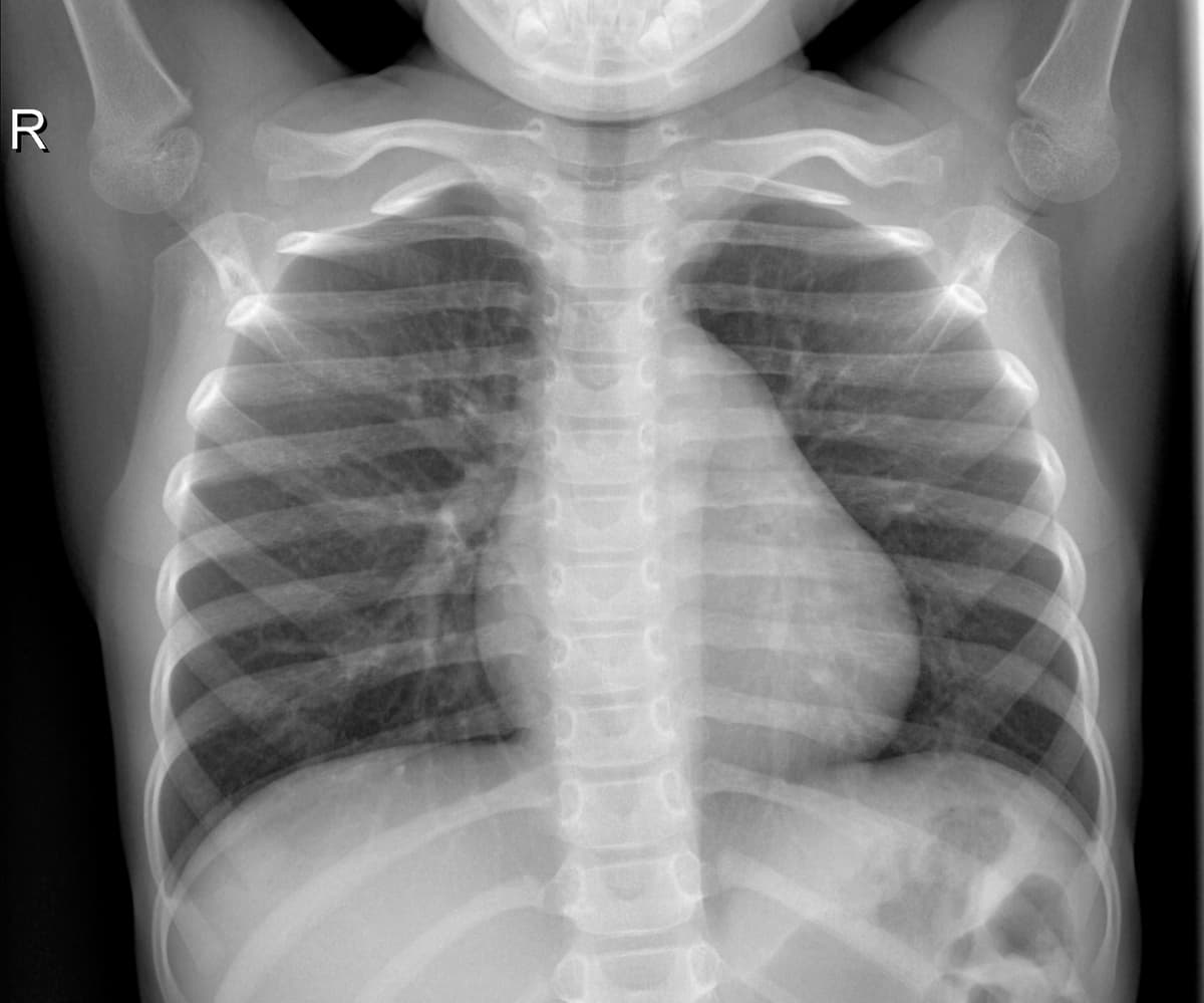 Radiografia Normal — NIH Chest X-ray14