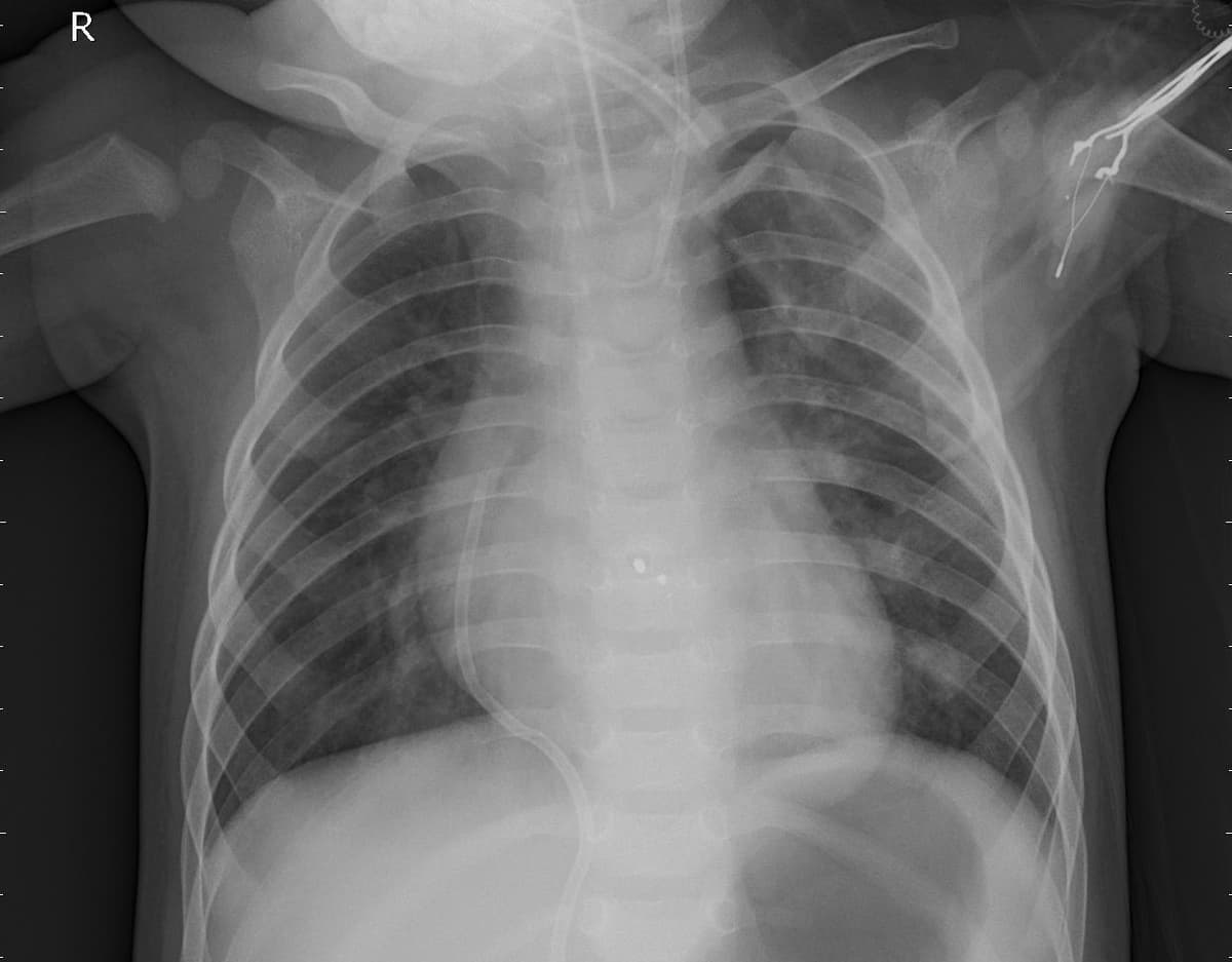 Pneumonia — NIH Chest X-ray14