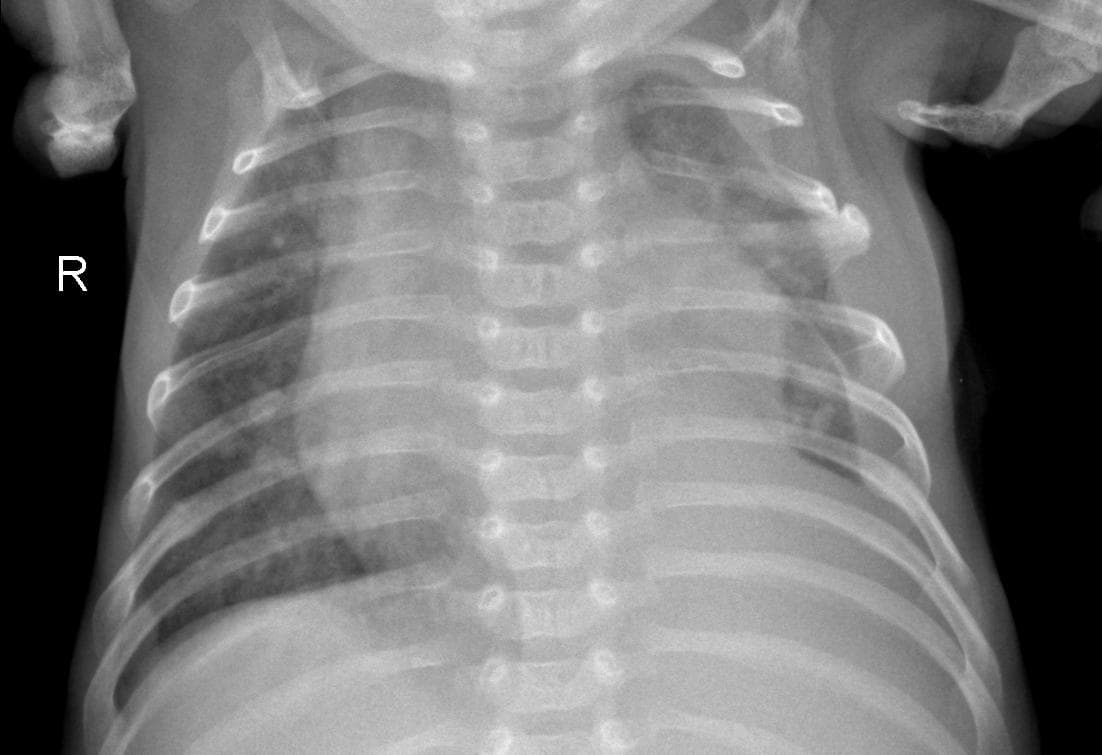 Pneumonia — NIH Chest X-ray14