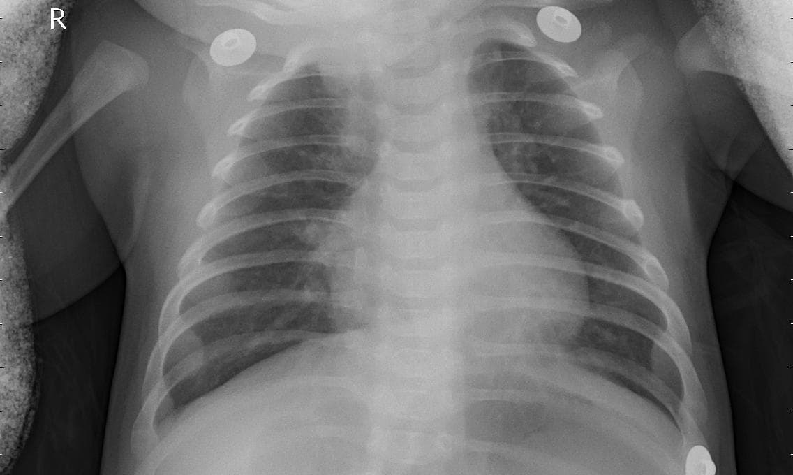Pneumonia — NIH Chest X-ray14