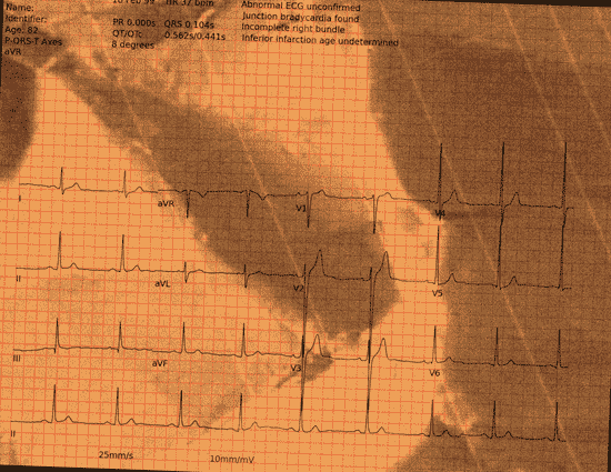 Normal ECG — PTB-XL
