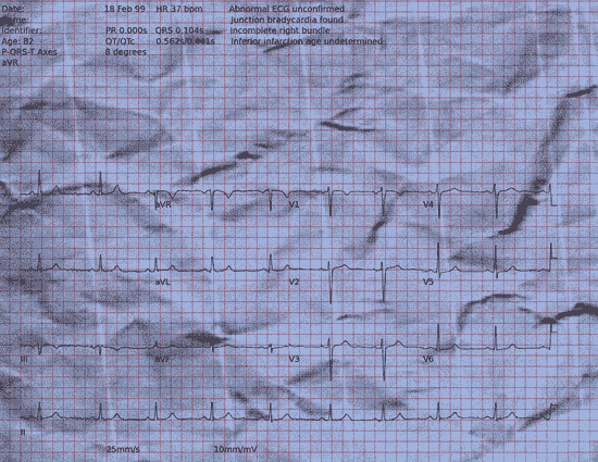 Normal ECG — PTB-XL
