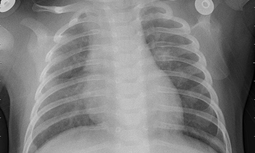 Pneumonia — NIH Chest X-ray14